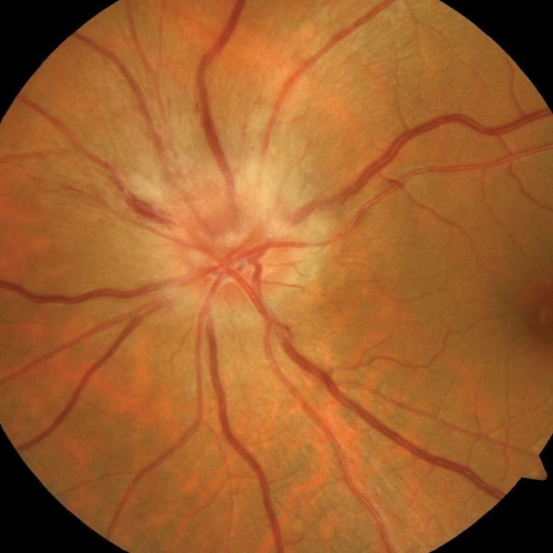 猛健樂視力模糊,猛健樂眼中風,猛健樂失明,猛健樂視力副作用,猛健樂視力模糊dcard