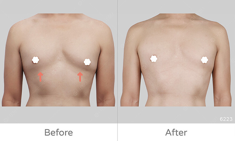 激凸,男生激凸的原因,激凸怎麼辦,怎麼消除激凸