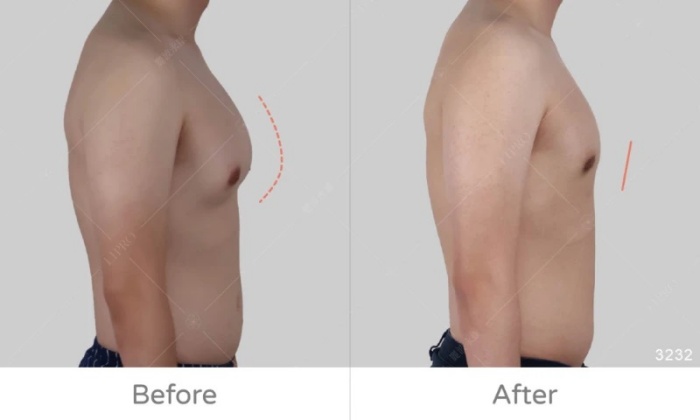 激凸,男生激凸的原因,激凸怎麼辦,怎麼消除激凸