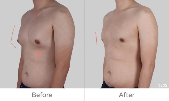 激凸,男生激凸的原因,激凸怎麼辦,怎麼消除激凸