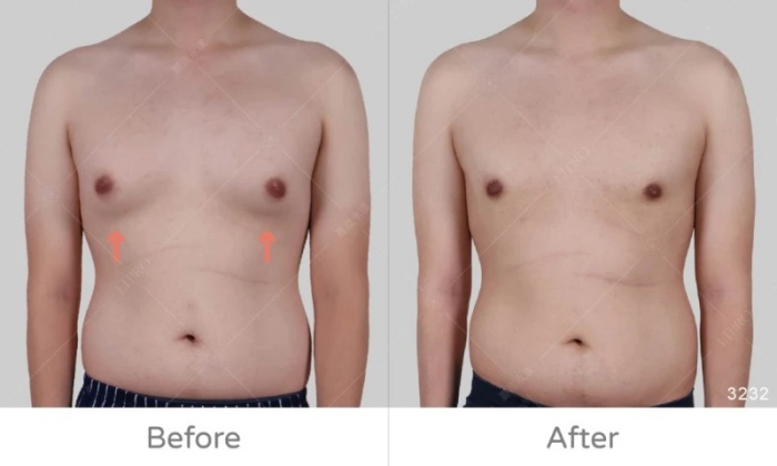 激凸,男生激凸的原因,激凸怎麼辦,怎麼消除激凸