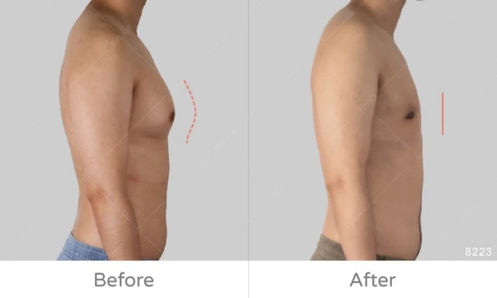 激凸,男生激凸的原因,激凸怎麼辦,怎麼消除激凸