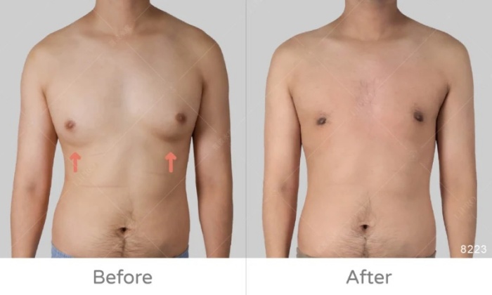 激凸,男生激凸的原因,激凸怎麼辦,怎麼消除激凸