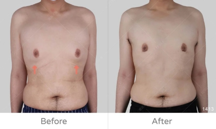 激凸,男生激凸的原因,激凸怎麼辦,怎麼消除激凸