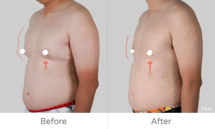 激凸,男生激凸的原因,激凸怎麼辦,怎麼消除激凸