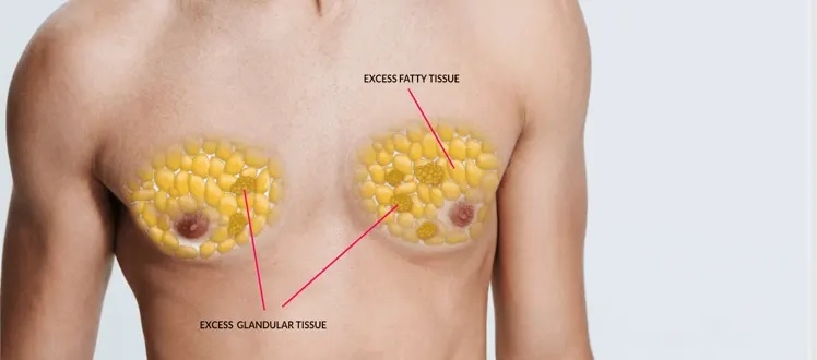 男性胸部有硬塊會痛,男生乳頭按壓會痛,男性乳頭痛