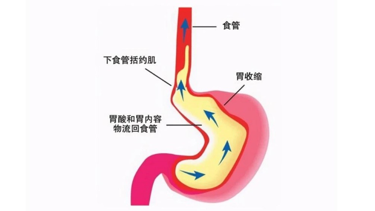 縮胃手術多久可以正常吃,縮胃手術後菜單,縮胃手術營養品,縮胃手術後一直吐,縮胃手術 掉髮