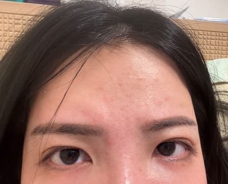 肉毒拉提,肉毒拉提的原理,肉毒拉提dcard,肉毒 拉提