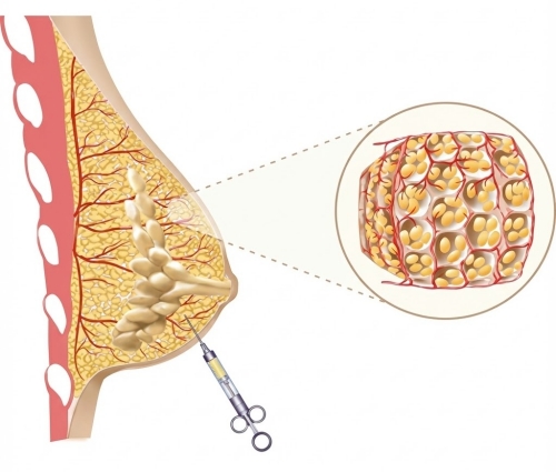 自體脂肪隆乳鈣化,乳房鈣化