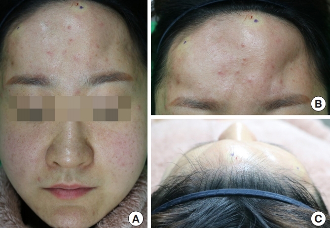 雅得媚失敗,雅得媚後遺症,雅得媚取出