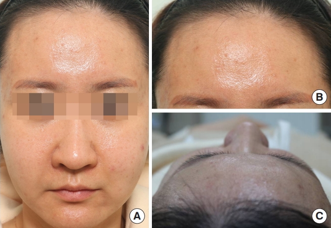 雅得媚失敗,雅得媚後遺症,雅得媚取出