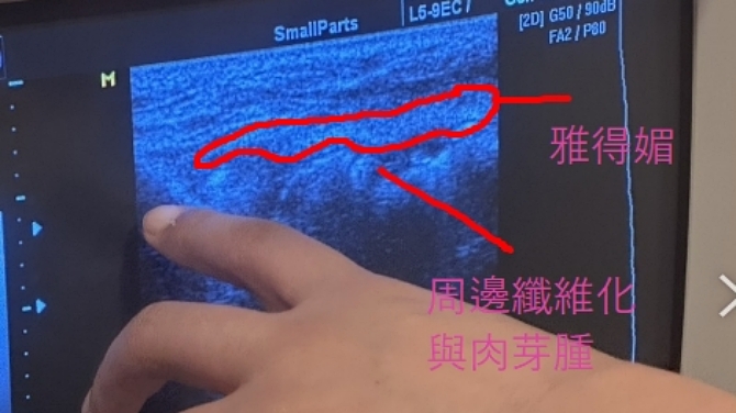 超音波影像顯示Aquamid中央低回音、周邊環狀高回音區,代表肉芽腫與纖維化