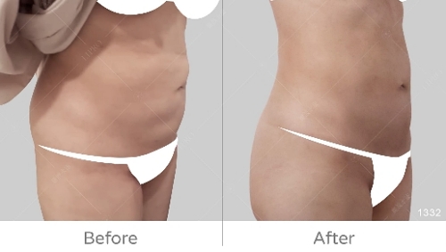 韓國抽脂dcard,韓國抽脂,腹部抽脂失敗