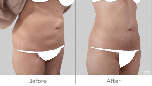 韓國抽脂dcard,韓國抽脂,腹部抽脂失敗