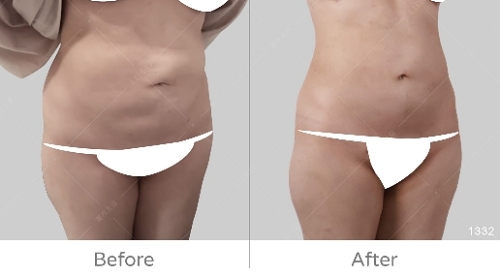 韓國抽脂dcard,韓國抽脂,腹部抽脂失敗