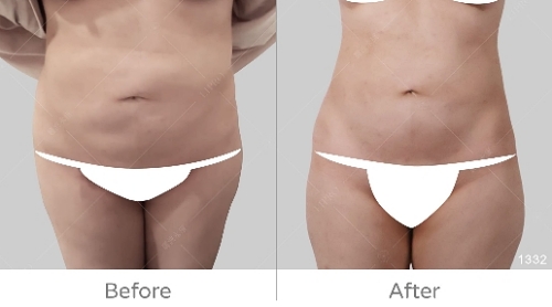 韓國抽脂dcard,韓國抽脂,腹部抽脂失敗