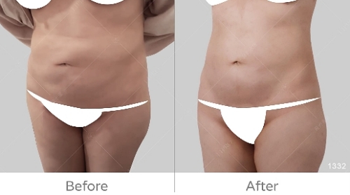 韓國抽脂dcard,韓國抽脂,腹部抽脂失敗