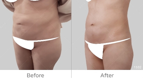 韓國抽脂dcard,韓國抽脂,腹部抽脂失敗