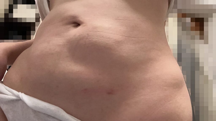 韓國抽脂dcard,韓國抽脂,腹部抽脂失敗