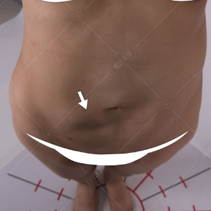 韓國抽脂dcard,韓國抽脂,腹部抽脂失敗