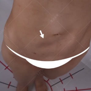 韓國抽脂dcard,韓國抽脂,腹部抽脂失敗