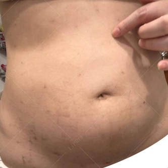 韓國抽脂dcard,韓國抽脂,腹部抽脂失敗