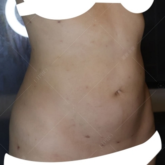 韓國抽脂dcard,韓國抽脂,腹部抽脂失敗