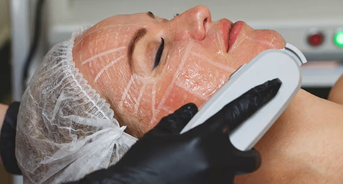 音波拉皮後遺症