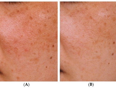 音波拉皮後遺症
