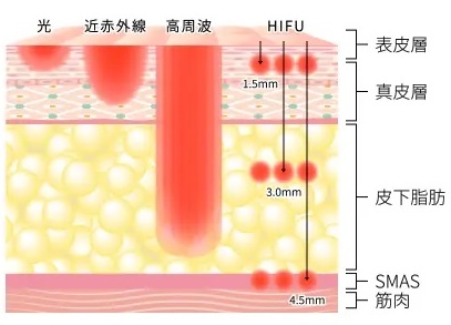 音波拉皮後遺症