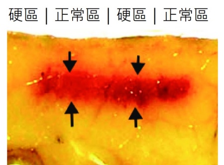 音波筋膜脆化dcard,筋膜脆化