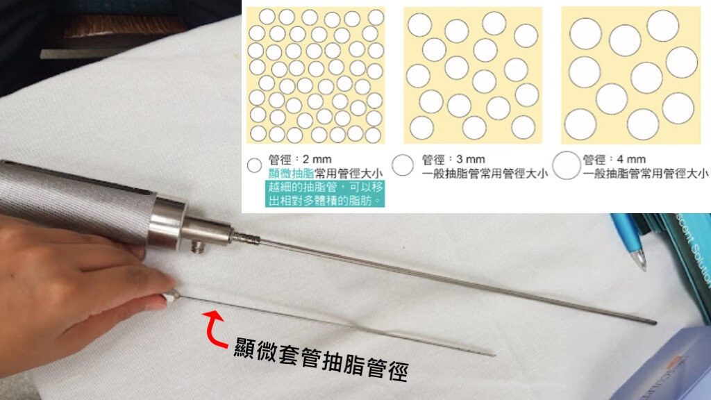 虎背熊腰,虎背熊腰改善,虎背熊腰原因,虎背熊腰運動