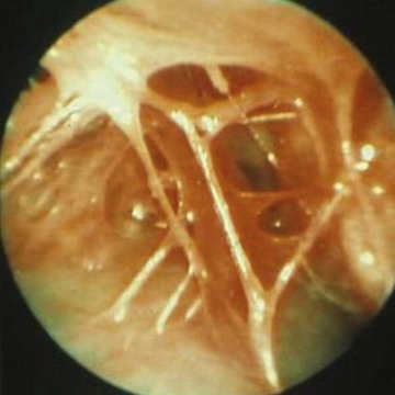 顯微套管抽脂,顯微套管抽脂費用,顯微套管抽脂缺點