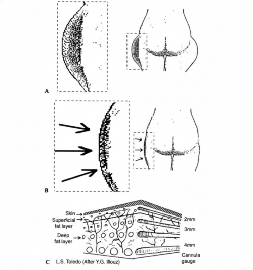 顯微套管抽脂,顯微套管抽脂費用,顯微套管抽脂缺點