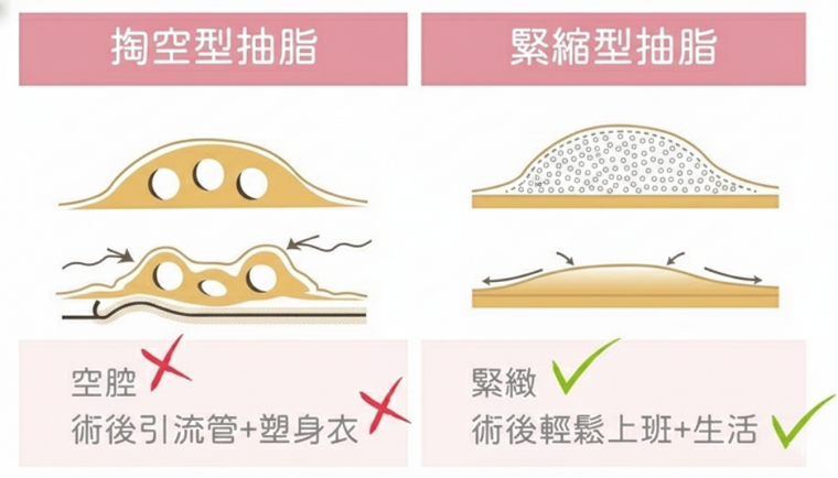 顯微套管抽脂,顯微套管抽脂費用,顯微套管抽脂缺點