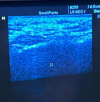 饅化怎麼辦,饅化修復,饅化原因,超音波饅化臉