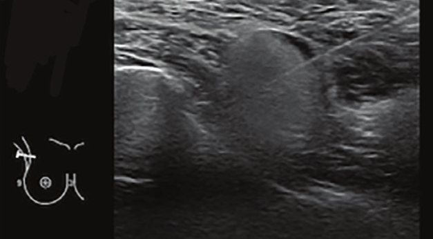 矽膠饅化超音波