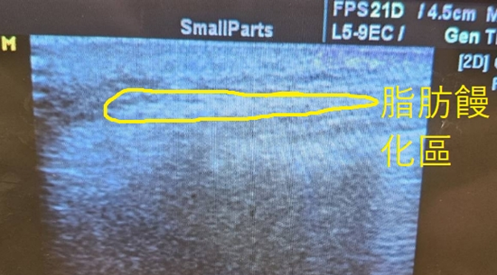脂肪饅化超音波