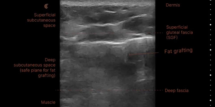 饅化怎麼辦,饅化修復,饅化原因,超音波饅化臉