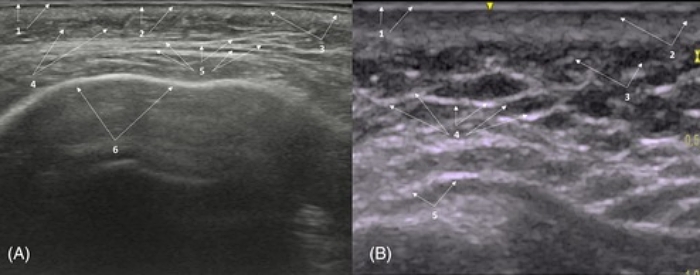 饅化怎麼辦,饅化修復,饅化原因,超音波饅化臉
